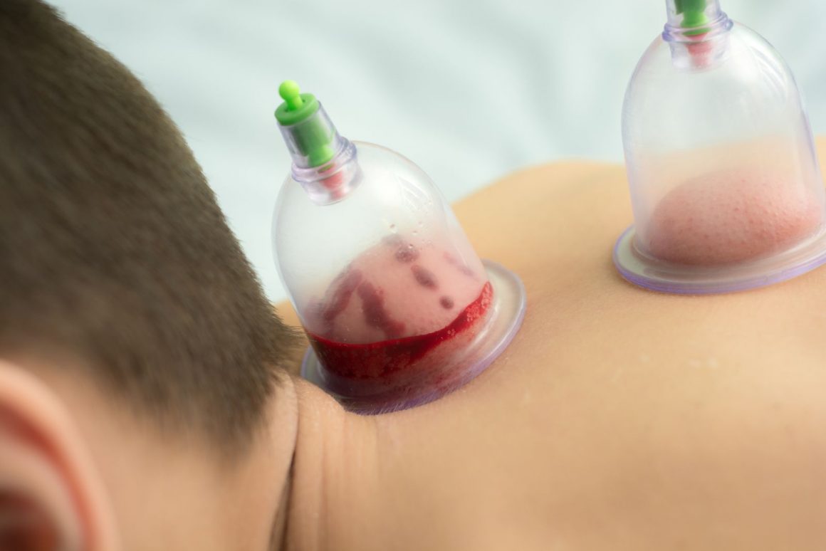 sumeyye-tereci-hacamat-izmir Hacamat (Kupa Terapisi)